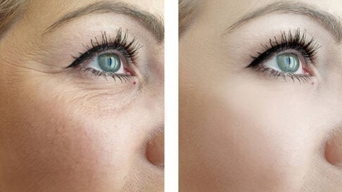 mínimo Montón de flexible Cómo eliminar las arrugas del contorno de ojos - Cremas regeneradoras,  naturales y antioxidantes - Bioxán